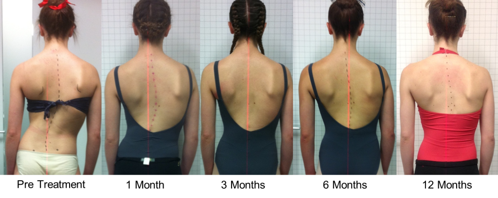 Sydney escoliose Clínica Caso 1 Resultado Sydney escoliose Clínica Caso 1 Resultado